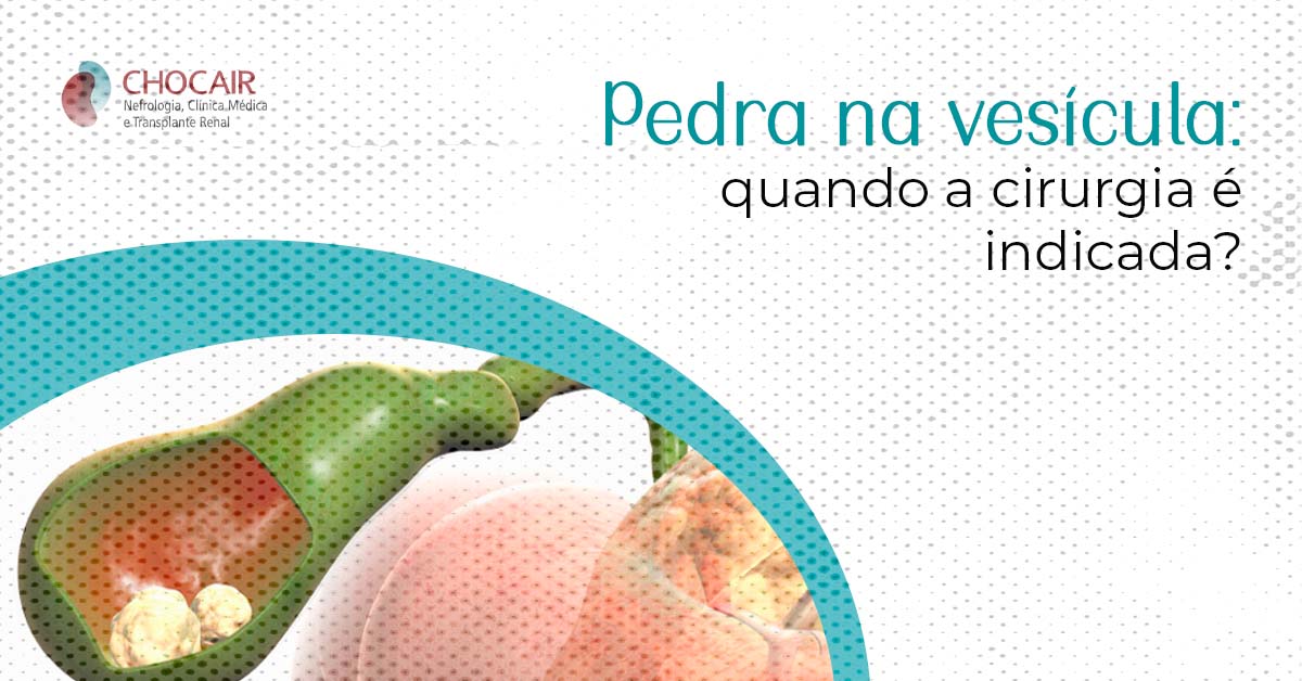 Pedra na Vesícula quando a cirurgia é indicada Chocair Médicos